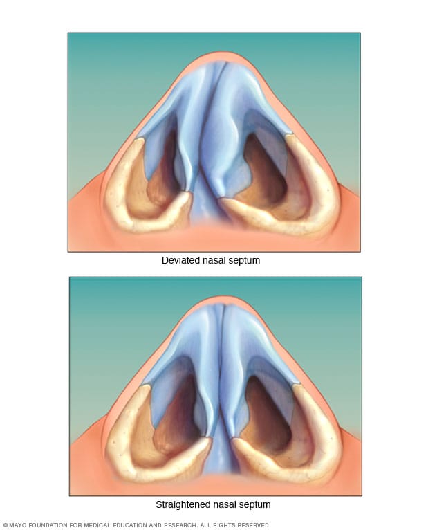 Overview Deviated septum Mayo Clinic